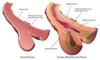 سیستیک فیبروزیس (Cystic Fibrosis)